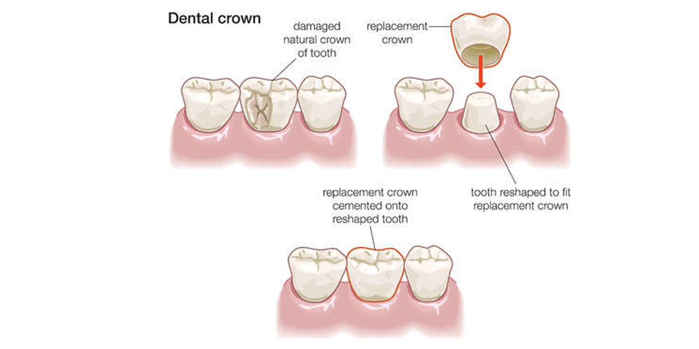 adaptable dental prosthesis The Right Way